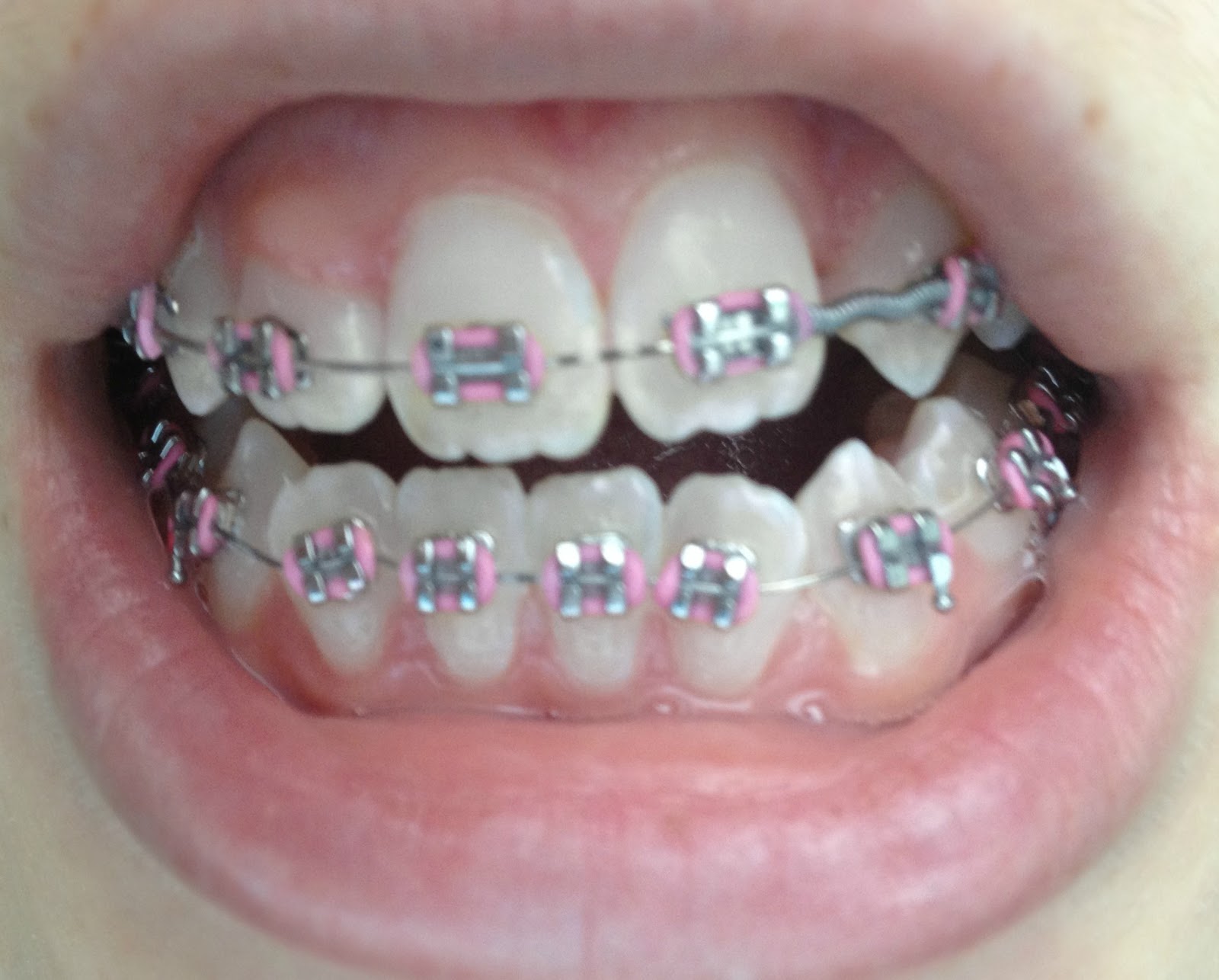 braces bottom teeth mouth jaw cassie update bumps surgery
